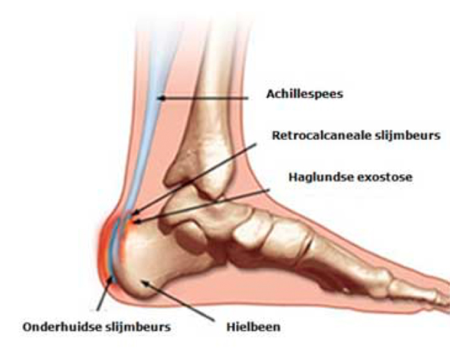 Stekende pijn aan de achterkant van de hiel